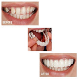 Cosmetic Dentistry Snap On Smile Instant Perfect Teeth Fits
